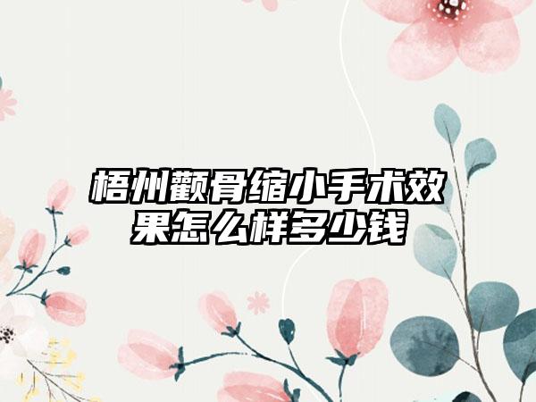 梧州颧骨缩小手术效果怎么样多少钱