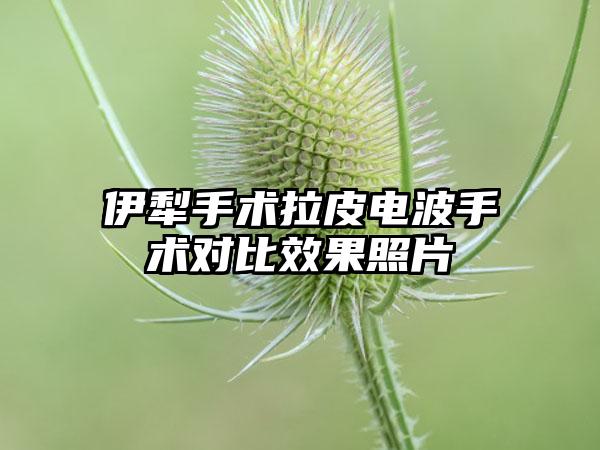 伊犁手术拉皮电波手术对比效果照片